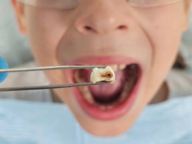 Best Emergency Wisdom Tooth Extraction in Big Rapids, MI